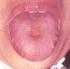 Lengua con marcas